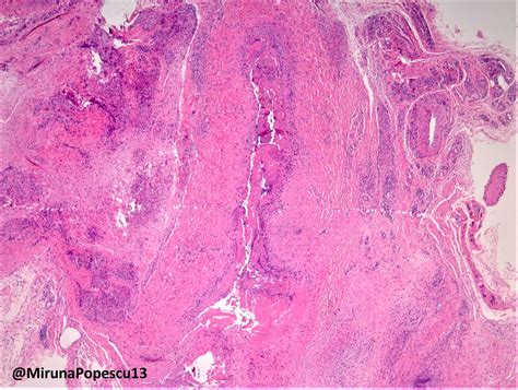 Pathology Outlines Rheumatoid Arthritis