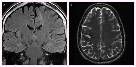 7 A Coronal Flair Mri Showing Focal Cortical Dysplasia In The