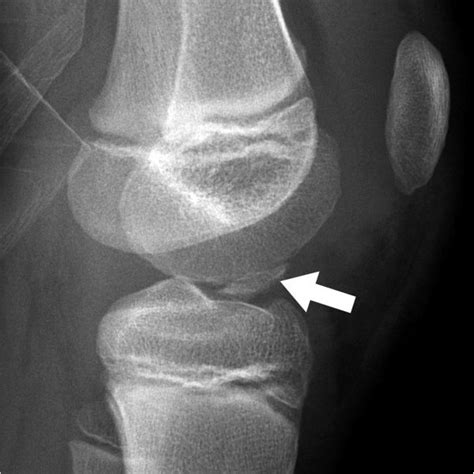 Lateral Radiograph Displaying The Displaced Tibial Spine Arrow