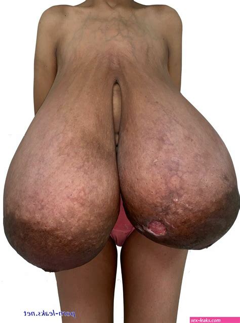 Photos Of Naked Women With Gigantomastia Sex Leaks