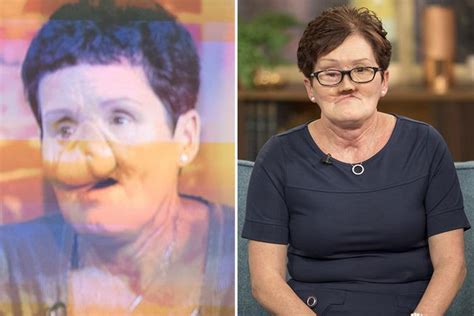 Grandmother Who Lost Her Nose And Teeth To Cancer Reveals New Look