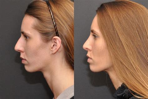 Rhinoplasty Nose Reshaping Page 2 Of 3