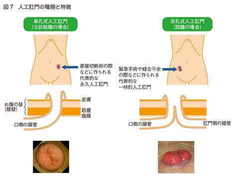 人工肛門とは：がんナビ