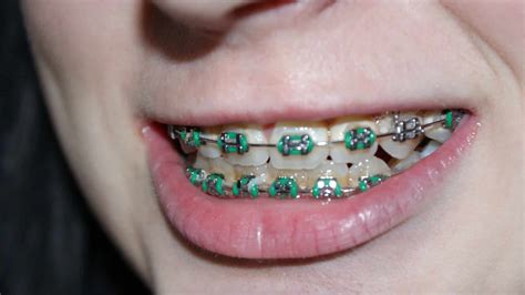 What Age Should You Get Braces Sing Orthodontics