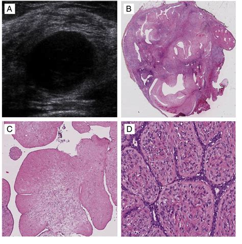 Figure 1 From Benign Phyllodes Tumor Of The Breast Recurring As A