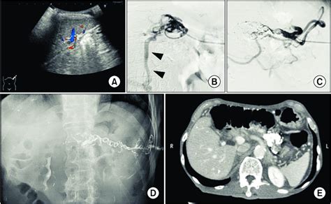 Second Interventional Radiology Ir Procedure Transsplenic Antegrade