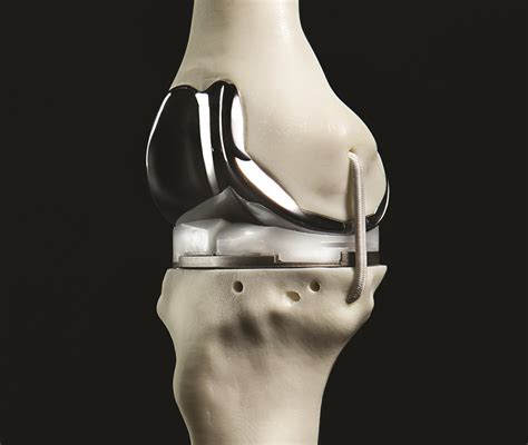 The Future Is Now Christ Hospital Creates 3d Printed Knee Implants
