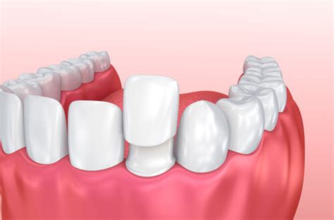 Since most insurance companies consider veneers a cosmetic procedure, most insurance plans will not cover. Cost of Veneers package | Dental Clinic in Dubai
