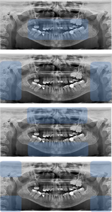 Areas Of Interest In The Panoramic Radiograph For Radiographic