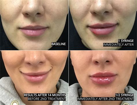 How To Reduce Swelling After Cheek Fillers