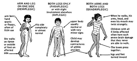 Several cerebral palsy classification systems exist today to define the type and form of cerebral palsy an individual has. Spastic Cerebral Palsy. Causes, symptoms, treatment ...