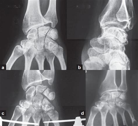 Preoperative X Rays Of The Wrist Left Side Anteroposterior Aand