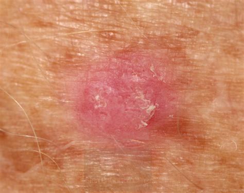 Skin Cancer And Precancerous Skin Lesions What You Need To Know Skin