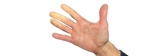 Raynauds Disease Causes Symptoms And Treatment
