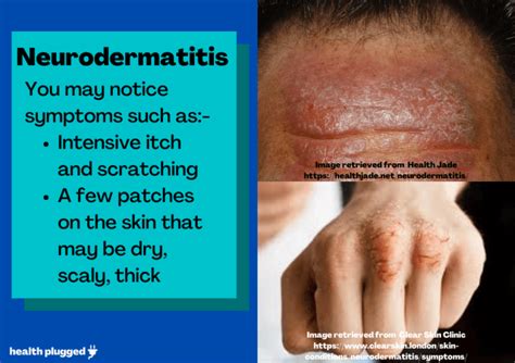 Types Of Eczema Symptoms Pictures Causes And Treatment