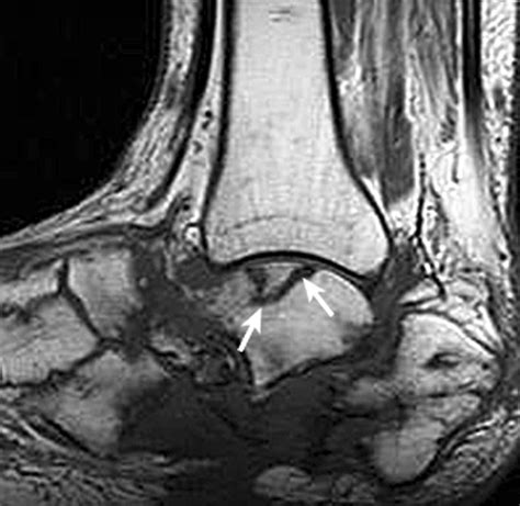 Avascular Necrosis Of The Talus A Pictorial Essay Radiographics