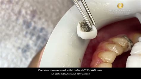 Zirconia Crown Removal With Litetouch™ Eryag Laser Youtube