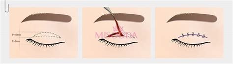 why korean double eyelid surgery guide reviews images promotions misooda