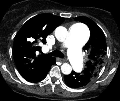 Contrast‐enhanced Computed Tomography Of The Chest Showing Intraluminal