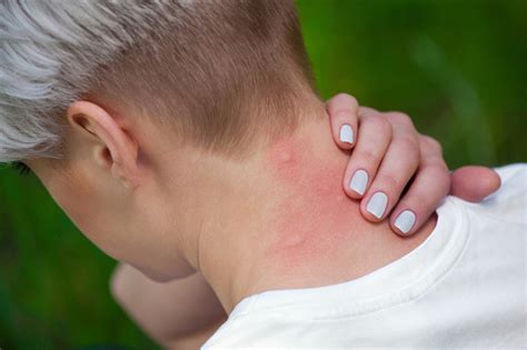 Mosquito Bite To The Neck Stock Photo Download Image Now Istock