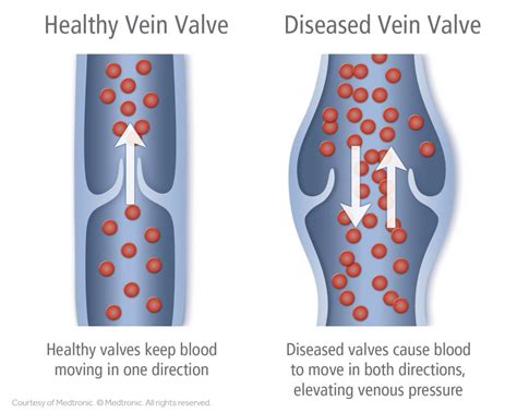 Venous Insufficiency Heart Of Dixie Vein And Vascular Center