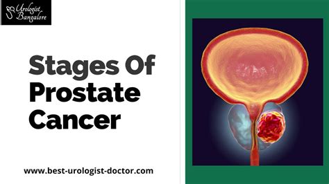Stages Of Prostate Cancer Prostate Cancer Treatment In Bangalore Best