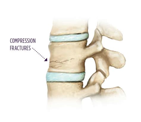 Treating Compression Fractures With Kyphoplasty Huffman Spine Clinic