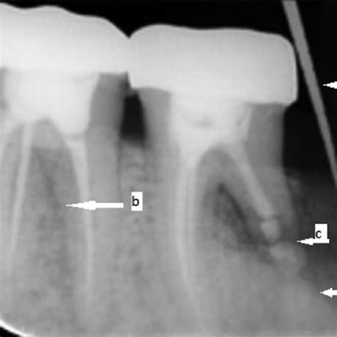 Follow Up Radiograph After 3 Months A Periodontal Pocket 4 Mm B