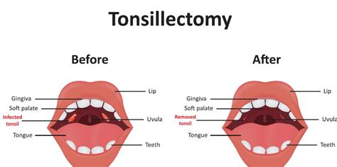 Tonsil Infection After Removal
