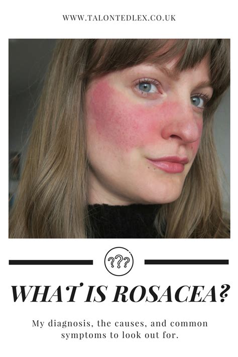 What Is Rosacea My Diagnosis And Common Symptoms Talonted Lex