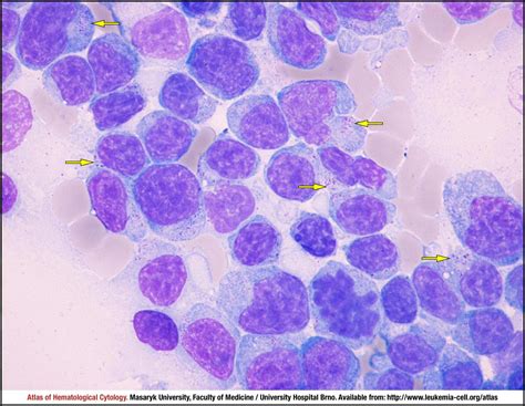 Hepatosplenic T Cell Lymphoma Cell Atlas Of Haematological Cytology