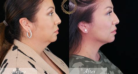 Non Surgical Neck Lift Top 5 Ways To Revitalize Your Neck