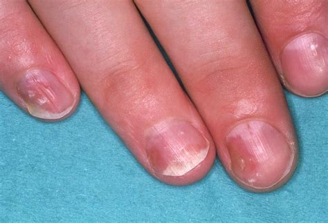Close Of Psoriasis Causing Pitting Of Fingernails Photograph By Science