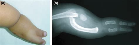 Skin Dimples Kumar 2014 International Journal Of Dermatology