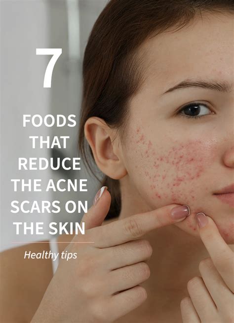 7 Foods That Reduce The Acne Scars On The Skin