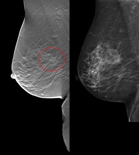 True Breast Tomosynthesis 3d Mammography