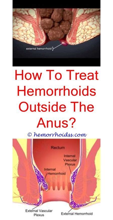 Pin By Emad Abdullah On Arabic With Images Hemorrhoids Hemorrhoid
