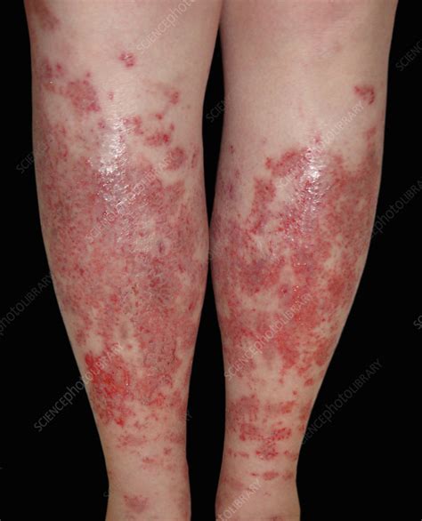 Acute Eczema Stock Image C0402302 Science Photo Library