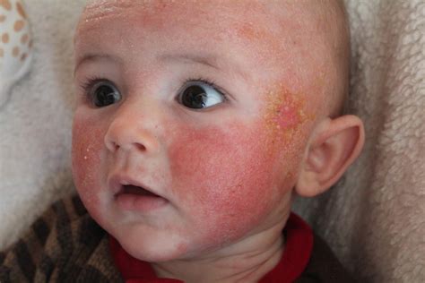 Please Help Identify This Facial Rash Pic Inc Babycenter