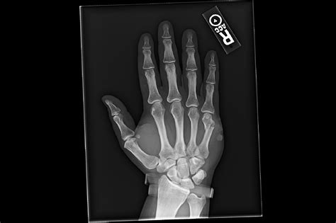 Ortho Dx Open Fracture Of The Hand Clinical Advisor