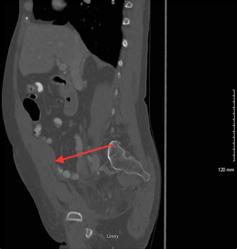 Spontaneous Rectus Sheath Haematoma Secondary To Severe Coughing In A