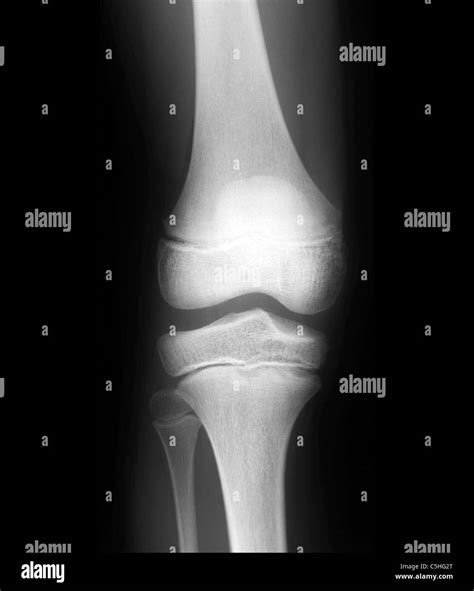 Normal Knee X Ray High Resolution Stock Photography And Images Alamy
