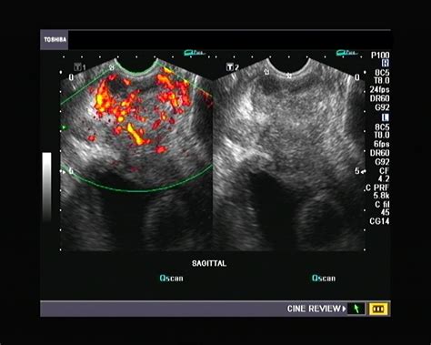 Ultrasound And Color Doppler Videos Prostate Transrectal Ultrasound Quiz