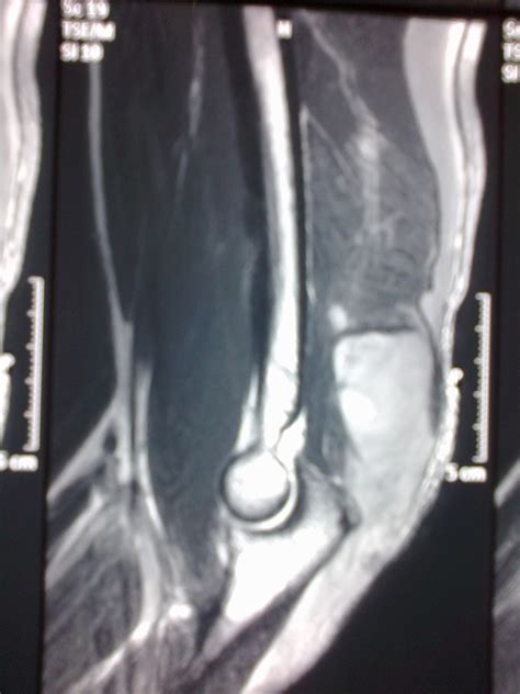 Triceps Tendon Rupture An Uncommon Orthopaedic Condition Bmj Case