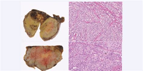 Typical Images Of Follicular Thyroid Carcinoma Gross Scale Bar 10