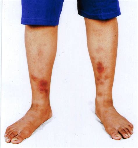 Erythema Nodosum Red Nodules Patches Pain On Shins