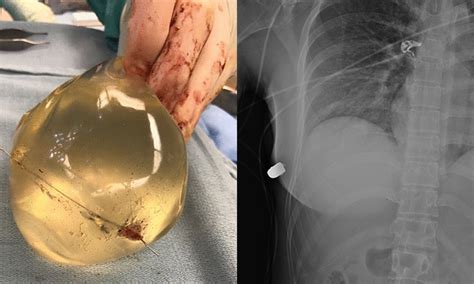 Womans Breast Implant Deflects Caliber Bullet Saving Her Life