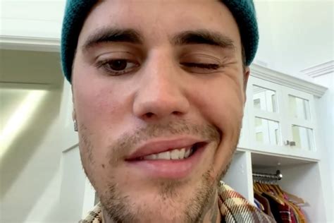 Justin Bieber Suffering Facial Paralysis Due To Ramsay Hunt Syndrome