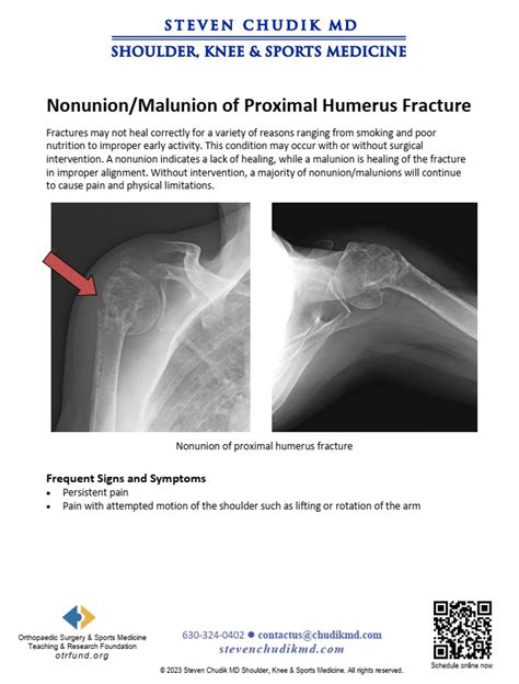 Nonunion Malunion Of Proximal Humerus Fracture Steven Chudik Md