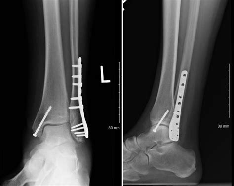 Patient Story Ankle Fracture Orthoinfo Aaos